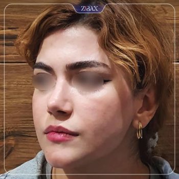نمونه عمل زیبایی بینی دکتر رضا کبودخانی شیراز