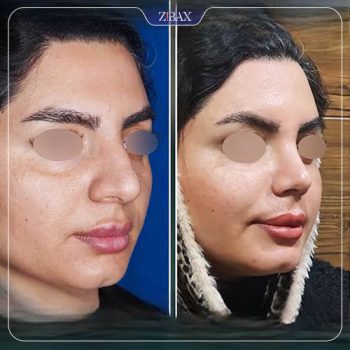 عکس نمونه کار جراحی بینی با دکتر رضا کبودخانی در شیراز