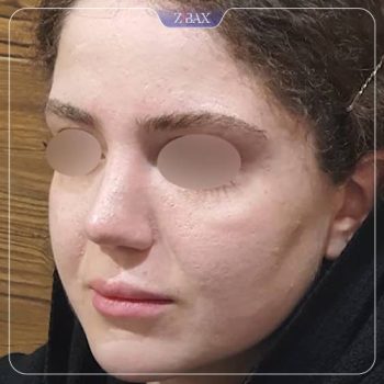 جراحی بینی توسط دکتر رضا کبودخانی در شیراز