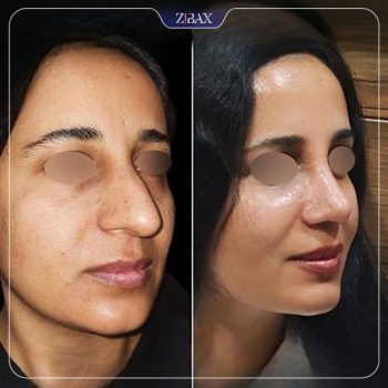 عکس جراحی زیبایی بینی توسط دکتر رضا کبودخانی در شیراز