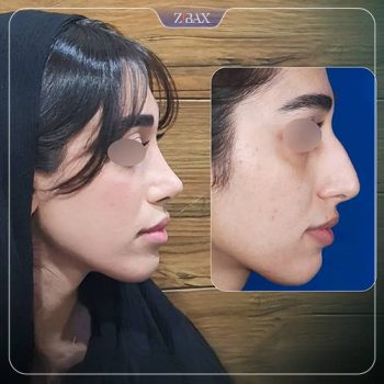 تصویر عمل زیبایی بینی با دکتر رضا کبودخانی در شیراز