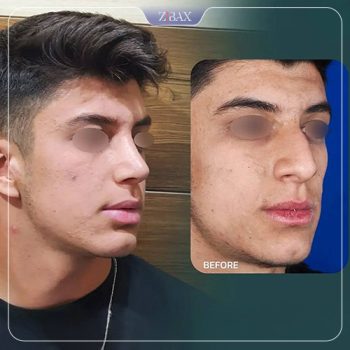نمونه کار عمل زیبایی بینی دکتر رضا کبودخانی در شیراز