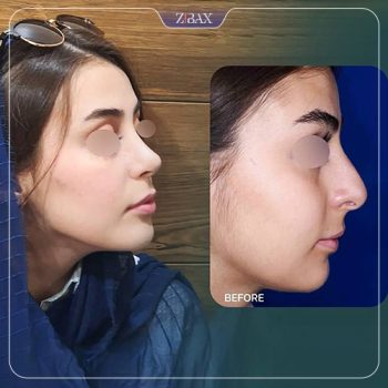 جراحی بینی با دکتر رضا کبودخانی در شیراز