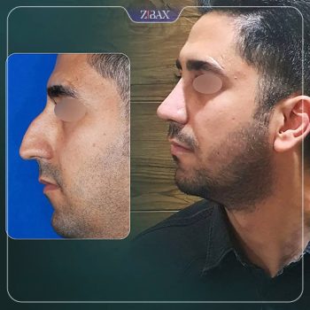 تصویر جراحی بینی توسط دکتر رضا کبودخانی در شیراز