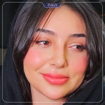 جراحی بینی توسط دکتر روزینا بشارتی زاده در تهران