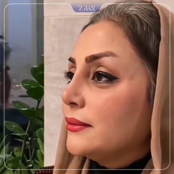 نمونه کار جراحی بینی دکتر رویا جاویدی