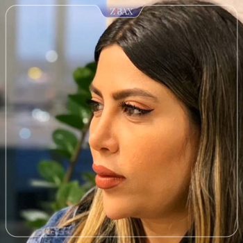 نمونه کار جراحی بینی دکتر رویا جاویدی