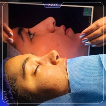 نمونه کار جراحی بینی دکتر رویا جاویدی