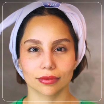 نمونه کار جراحی بینی دکتر رویا جاویدی