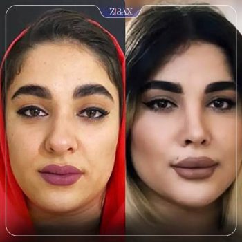 نمونه کار جراحی بینی دکتر زهرا خسروی