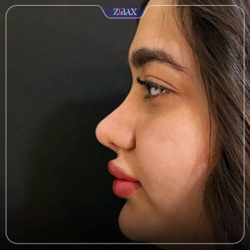 نمونه کار جراحی بینی دکتر زهرا خسروی