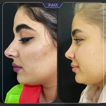نمونه کار جراحی بینی دکتر زهرا خسروی