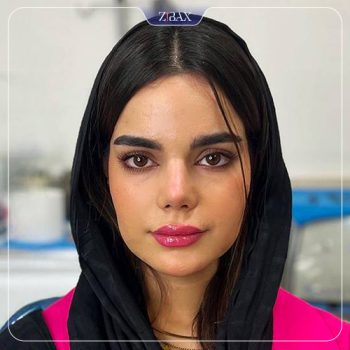 نمونه کار جراحی بینی دکتر سجاد پیشگر