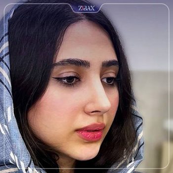 نمونه کار جراحی بینی دکتر سجاد پیشگر