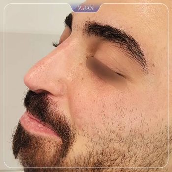 نمونه کار جراحی بینی دکتر شمیلا رضوانی نیا