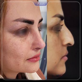 نمونه کار جراحی بینی دکتر شمیلا رضوانی نیا