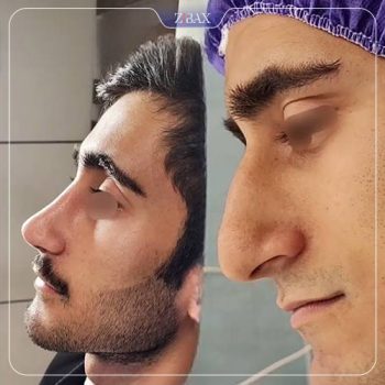 نمونه کار جراحی بینی دکتر شمیلا رضوانی نیا