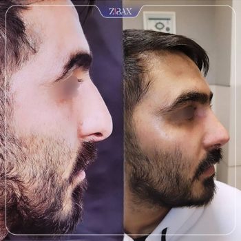 نمونه کار جراحی بینی دکتر شمیلا رضوانی نیا