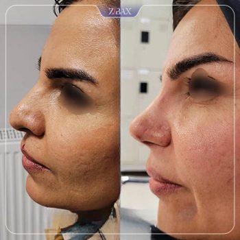 نمونه کار جراحی بینی دکتر شمیلا رضوانی نیا