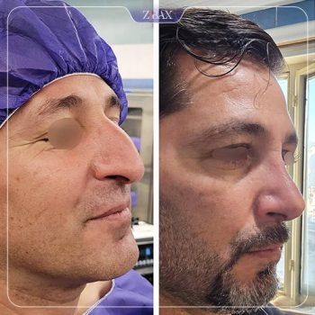 نمونه کار جراحی بینی دکتر شمیلا رضوانی نیا