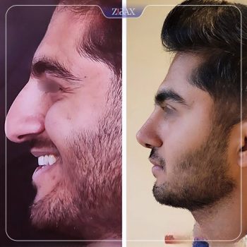 نمونه کار جراحی بینی دکتر شمیلا رضوانی نیا