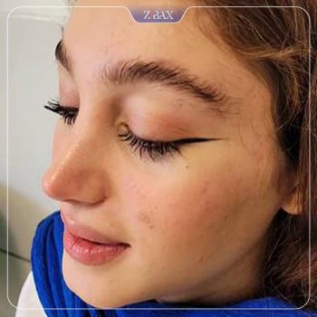 نمونه کار جراحی بینی دکتر شمیلا رضوانی نیا