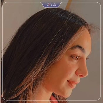 جراحی بینی توسط دکتر شهریار شاهمرادی در شیراز