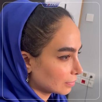 تصویر جراحی بینی توسط دکتر شهریار شاهمرادی در شیراز