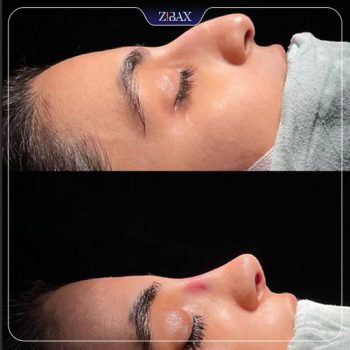 نمونه جراحی بینی با دکتر علیرضا مصباحی در شیراز