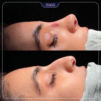 نمونه عمل زیبایی بینی دکتر علیرضا مصباحی شیراز