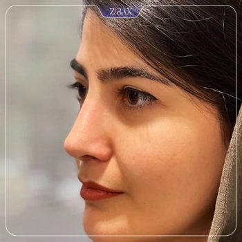 عکس نمونه کار جراحی بینی با دکتر علیرضا مصباحی در شیراز