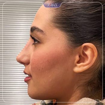 جراحی بینی توسط دکتر علیرضا مصباحی در شیراز