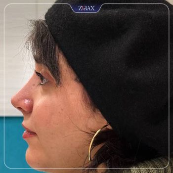 نمونه جراحی زیبایی بینی با دکتر علیرضا مصباحی جراح بینی شیراز