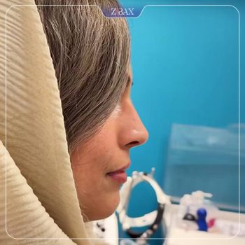 نمونه کار عمل زیبایی بینی دکتر علیرضا مصباحی در شیراز