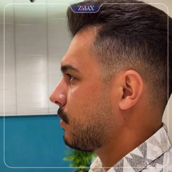 جراحی بینی با دکتر علیرضا مصباحی در شیراز