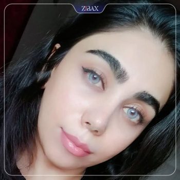 عکس نمونه کار جراحی بینی با دکتر غلامرضا معین در شیراز