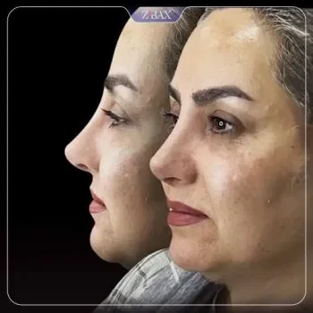 نمونه عمل بینی طبیعی دکتر پروانه روحانی کرمان