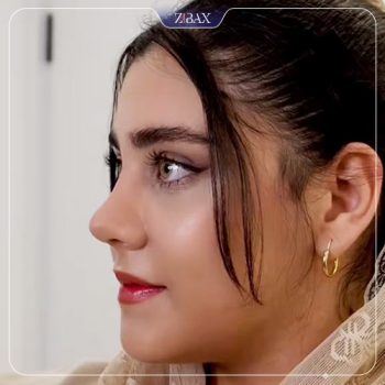 عکس جراحی زیبایی بینی توسط دکتر پیمان برومند در تهران