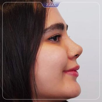 نمونه کار عمل زیبایی بینی دکتر پیمان برومند در تهران