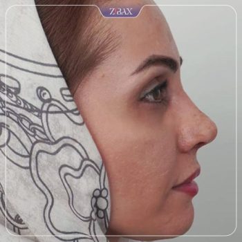 تصویر جراحی بینی توسط دکتر پیمان برومند در تهران