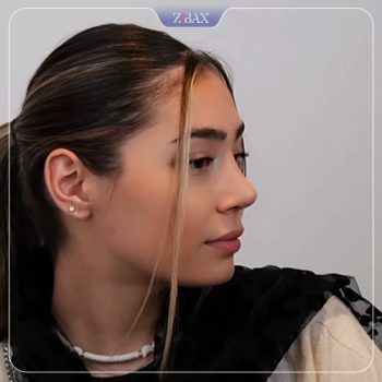 نمونه جراحی بینی با دکتر پیمان برومند در تهران