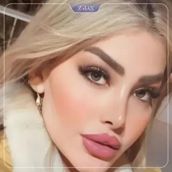 نمونه کار دکتر محسن روشنی جراح بینی شیراز