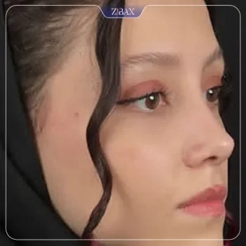 نمونه کار دکتر فرزان رضایی جراح بینی