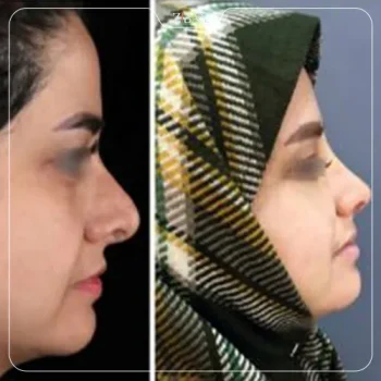 نمونه کار عمل بینی دکتر مرتضی نوری