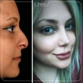 نمونه عمل بینی دکتر مرتضی نوری