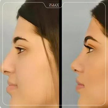 نمونه کار دکتر مرتضی نوری جراح بینی تهران