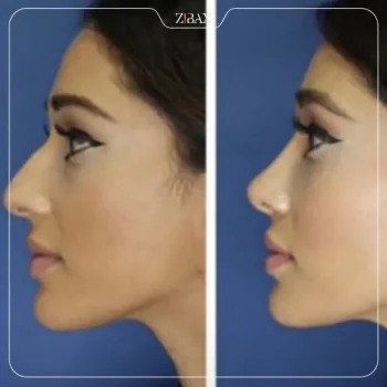 نمونه عمل بینی طبیعی دکتر مرتضی نوری