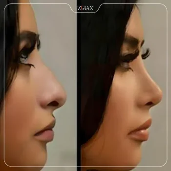 نمونه عمل بینی دکتر مرتضی نوری در تهران