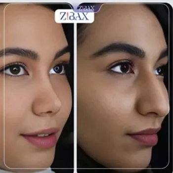 نمونه جراحی بینی دکتر چراغی پور