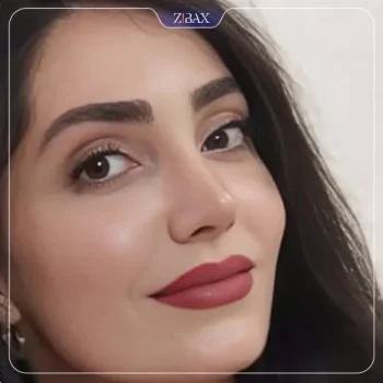 نمونه کار دکتر ابراهیمی جراح بینی تهران